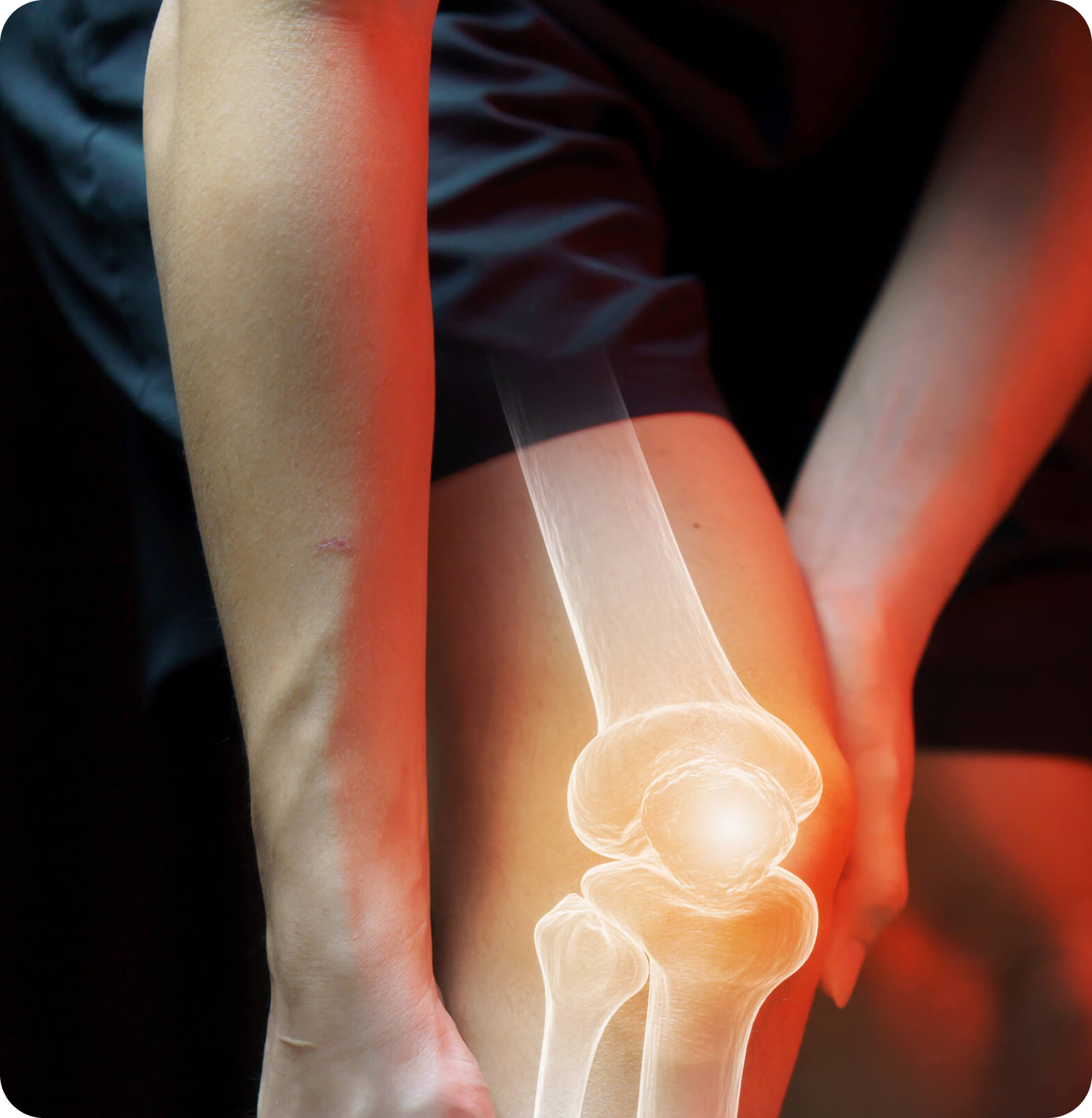An illustration of a knee joint highlighting the bones and surrounding tissues.